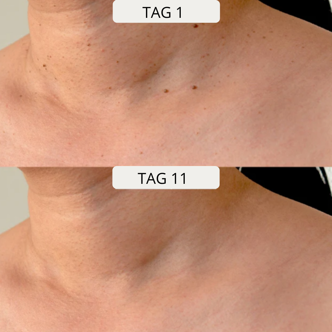 Lush TagPen Kit™ | Hautanhängsel einfach zu Hause entfernen