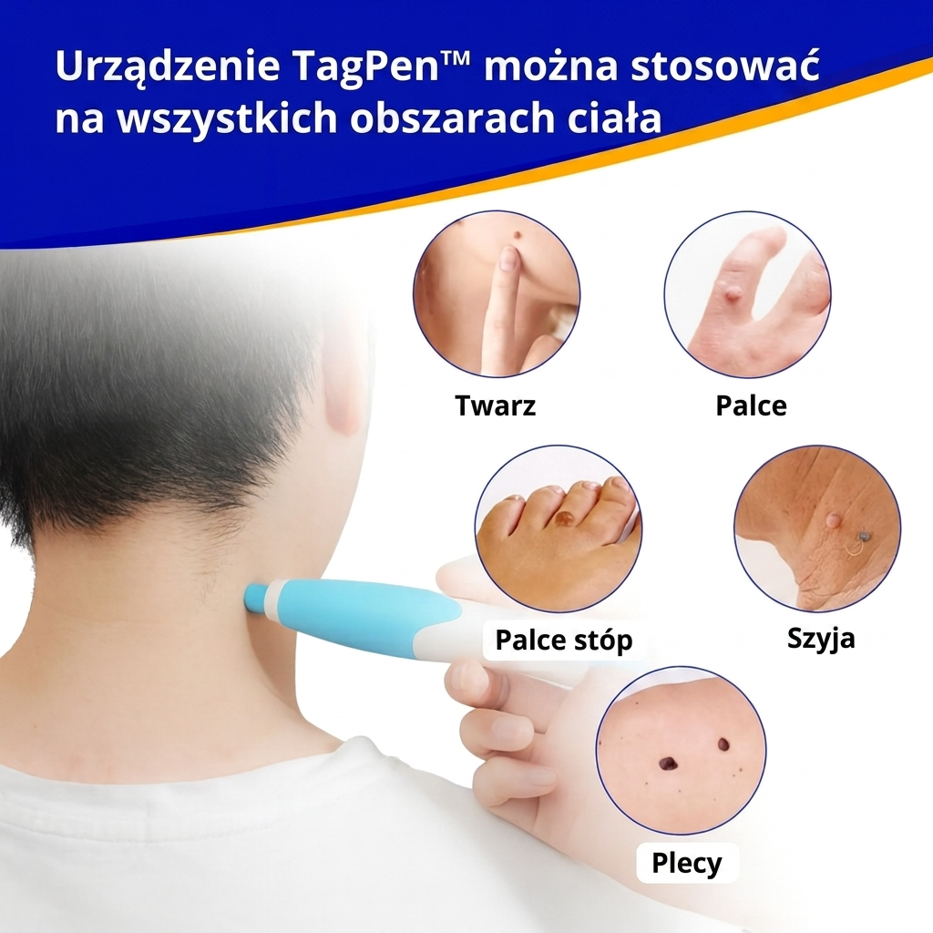 Lush TagPen Kit™ | Łatwe usuwanie włókniaków w domu