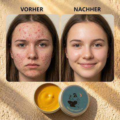 Ritual gegen Akne und Rötungen